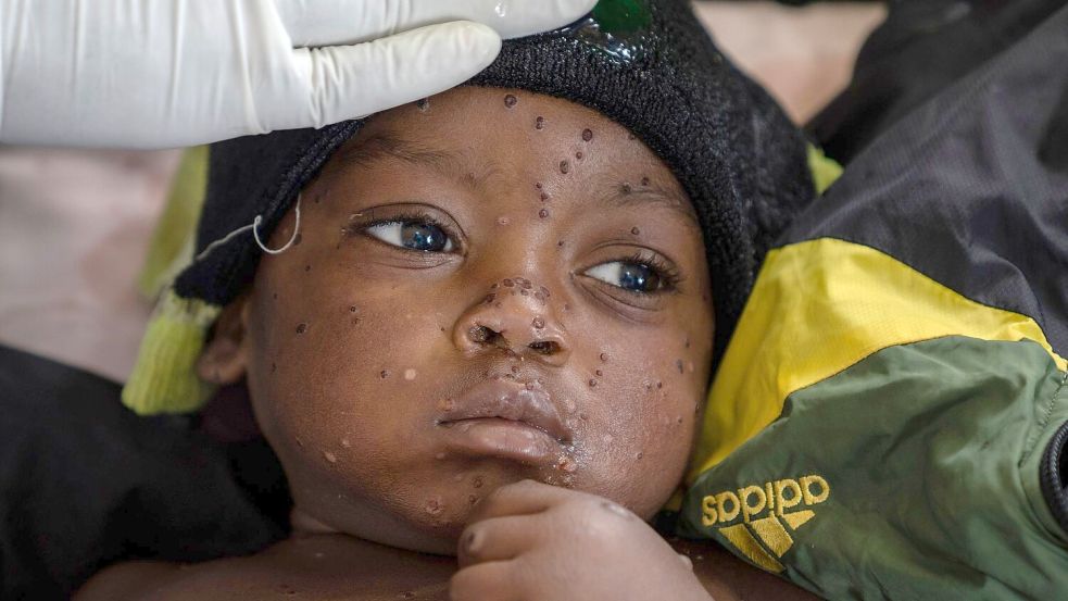 Neue Tests sollen die Ausbreitung von Mpox eindämmen helfen. (Archivbild) Foto: Moses Sawasawa/AP/dpa