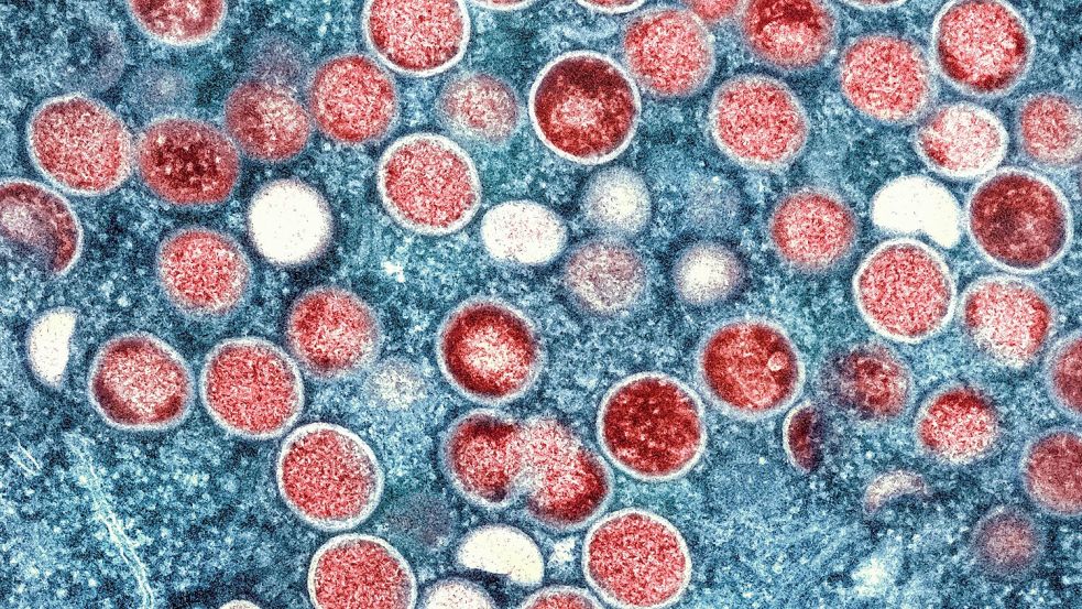 Eine eingefärbte Mikroskopaufnahme von Mpox-Partikeln. Foto: National Institute of Allergy and Infectious Diseases/AP/dpa