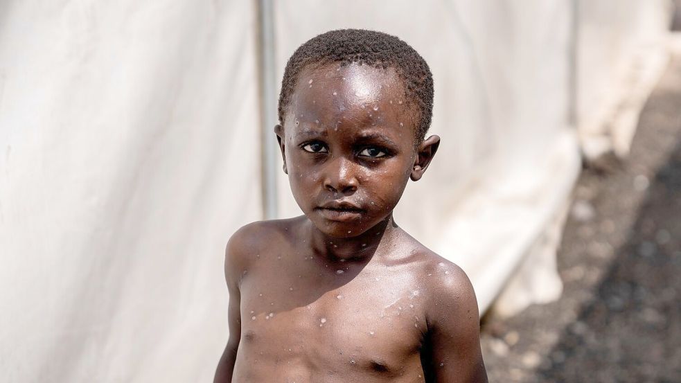 Für Kinder und immungeschwächte Menschen kann die Krankheit tödlich sein. (Archivbild) Foto: Moses Sawasawa/AP/dpa